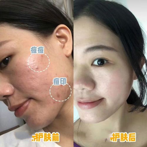 瓷妆祛痘产品效果真的好吗？-图1