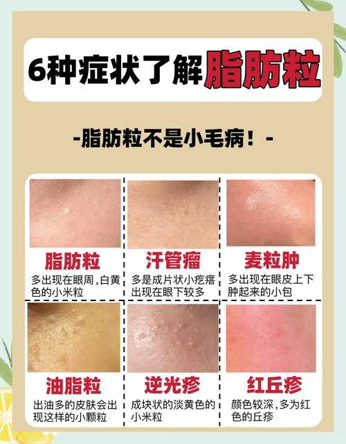 脂肪粒用什么护肤品能消？-图2