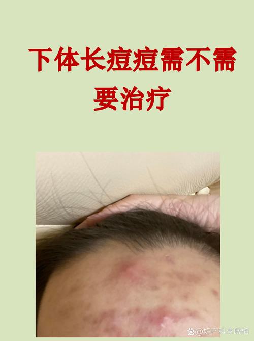 华大夫祛痘效果真的好吗？-图2