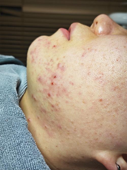 华大夫祛痘效果真的好吗？-图3