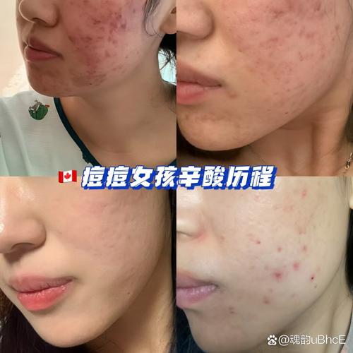 ve祛痘印效果真的好吗？-图2