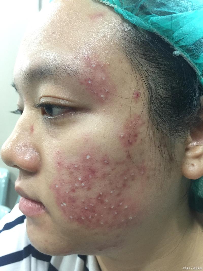 琳娜护肤祛痘是真的吗-图2