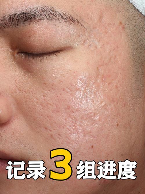 激光祛痘后痘痘会复发吗？-图1