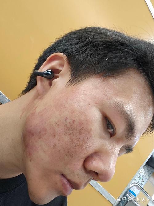 点阵激光祛痘坑效果图-图1