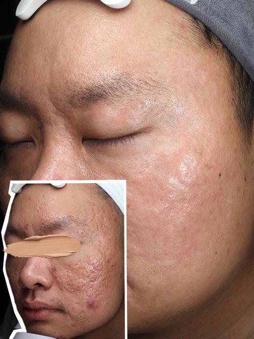 点阵激光祛痘坑效果图-图3