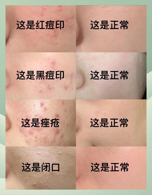 男生祛痘印，哪些方法最有效？-图1