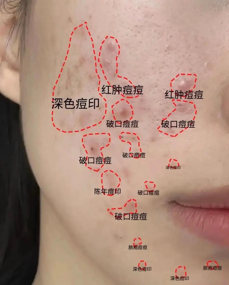 13岁青春期祛痘，该怎么做才有效？-图3