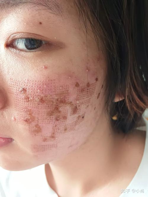 点阵激光祛痘印效果到底怎么样？-图2