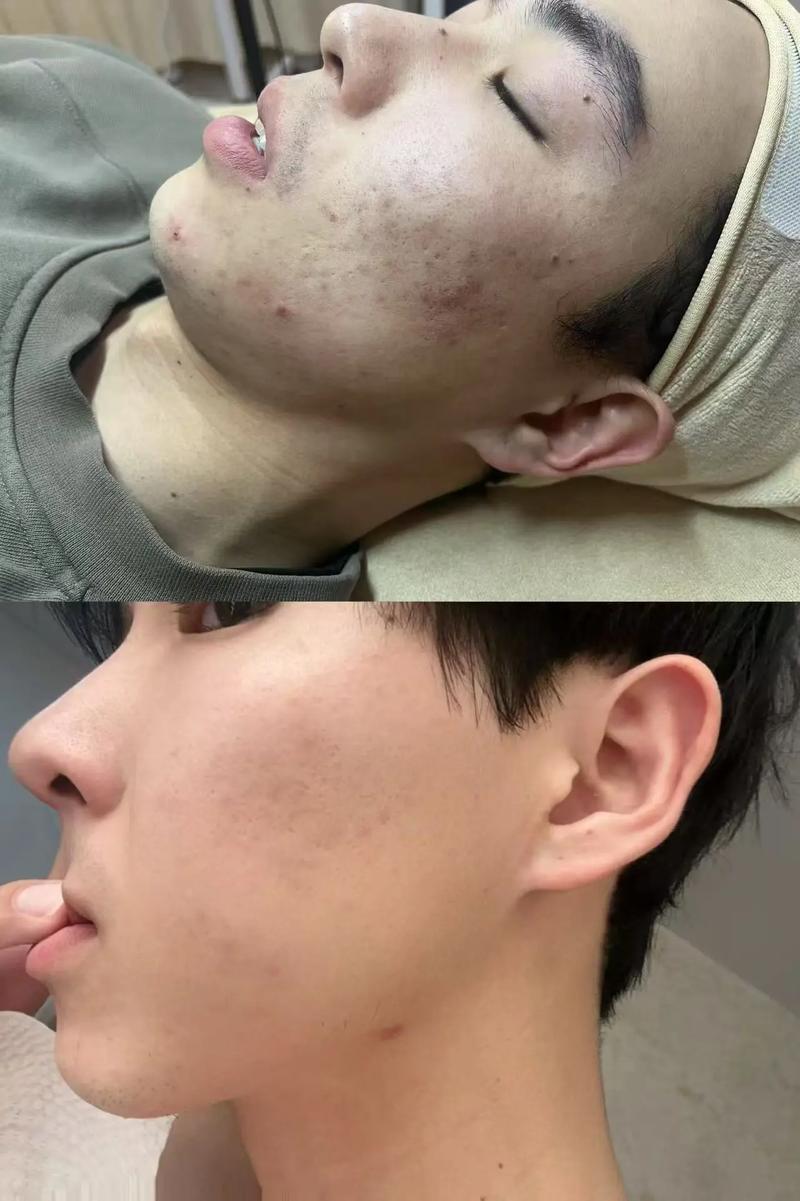 男生祛痘印美白，有哪些有效方法？-图1
