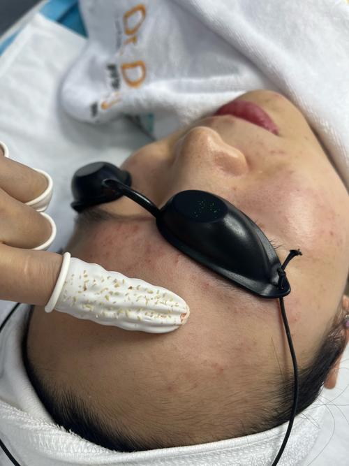 苗方清颜祛痘手法具体怎么操作？-图1