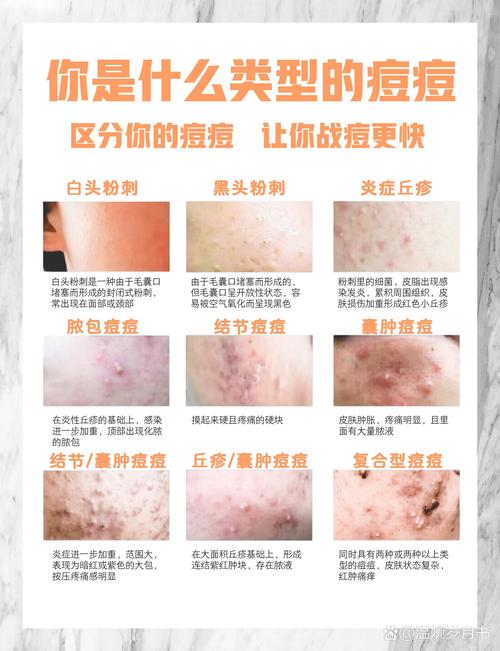 祛青春痘最有效方法是什么？-图3