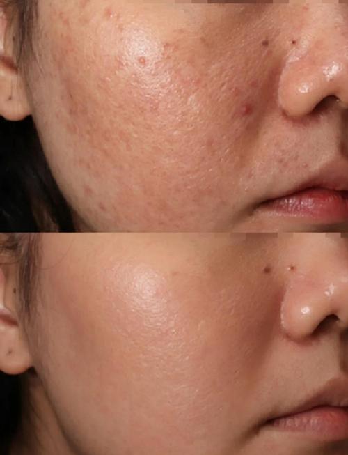 激光祛斑可以去痘印吗-图1