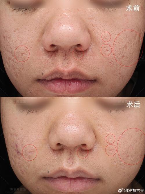 彩光祛痘印1次后效果能维持多久？-图1