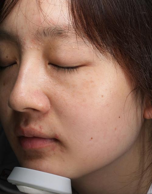 彩光祛痘印1次后效果能维持多久？-图2