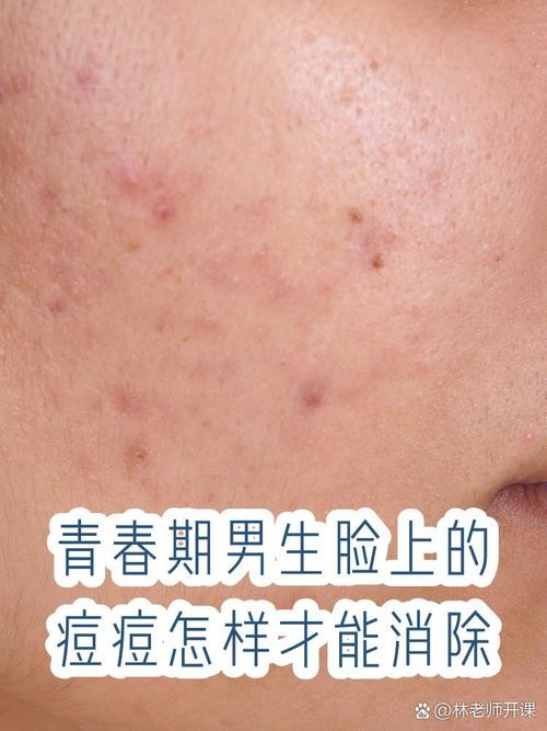 男生怎么祛痘印最快最有效？-图2