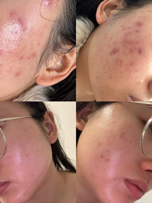 护肤品用后脸刺痛咋回事？-图1