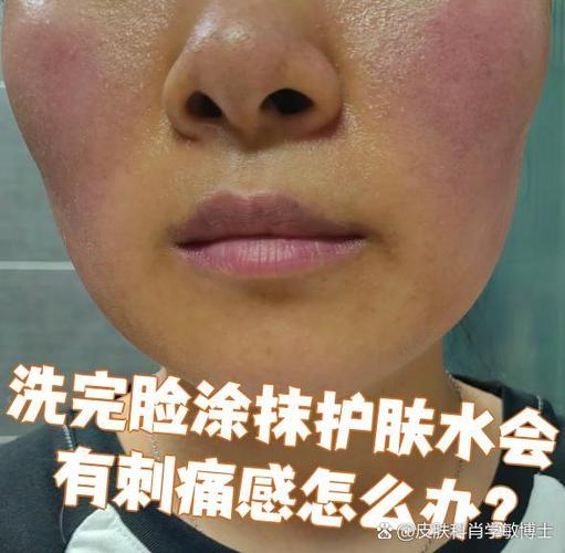 护肤品用后脸刺痛咋回事？-图2