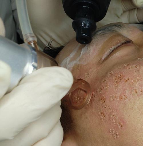 激光祛痘坑副作用有哪些？-图1