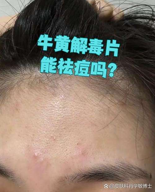 牛黄解毒丸能祛痘吗？-图3