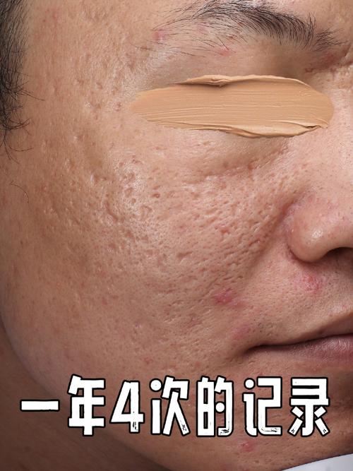 激光祛痘会留后遗症吗？-图2