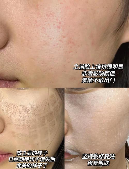 激光祛痘会留后遗症吗？-图1