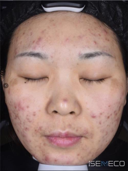 激光祛痘会留后遗症吗？-图3